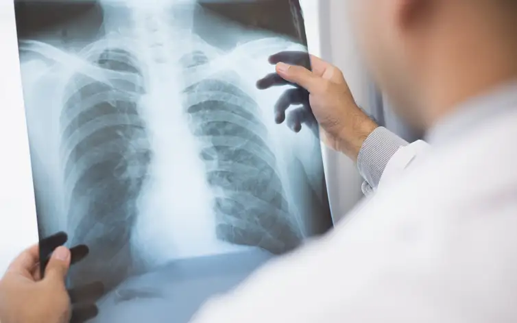 Anvisa aprova novo medicamento para tratamento de câncer de pulmão avançado